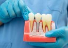 When Is a Root Canal Better Than Tooth Extraction?