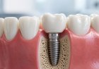 Why Choose a Dental Implant in Pitampura?