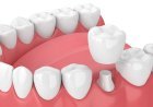 Dental Veneers vs Dental Crowns: Understanding Which Treatment Is Right for Your Smile