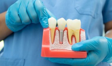 When Is a Root Canal Better Than Tooth Extraction?