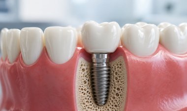Why Choose a Dental Implant in Pitampura?