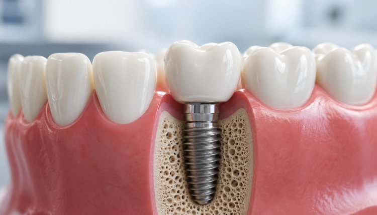 Why Choose a Dental Implant in Pitampura?